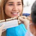FACCETTE DENTALI DONNA