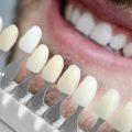FACCETTE DENTALI UOMO