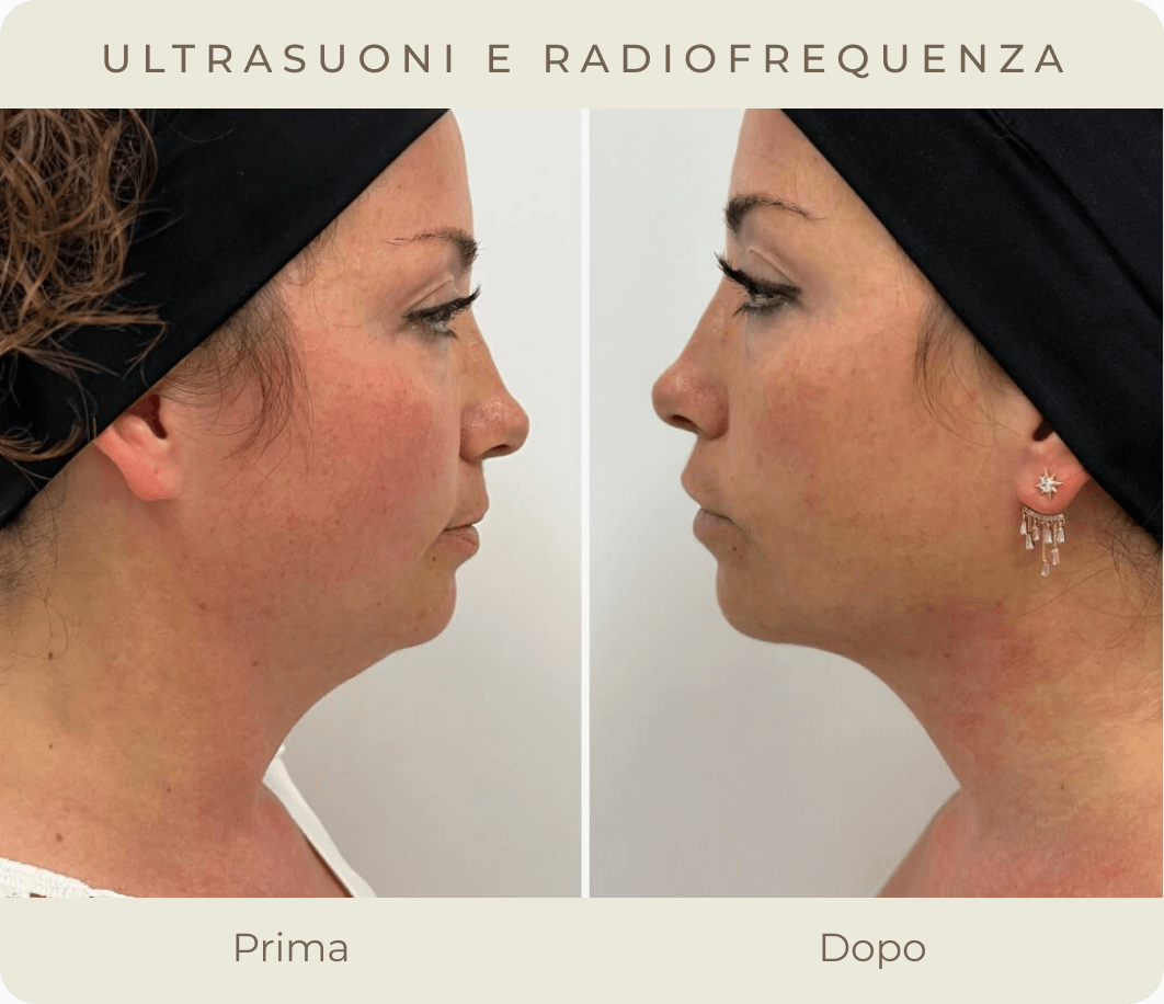 radiofrequenza
