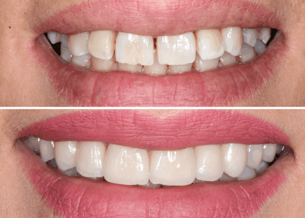 faccette-dentali