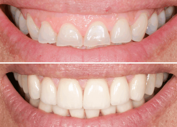 faccette-dentali2