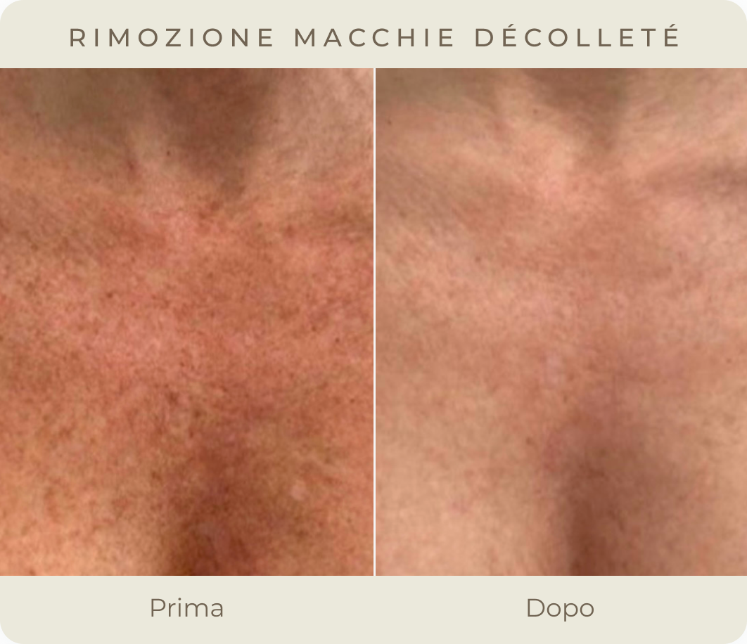 Macchie Décolleté Prima e Dopo