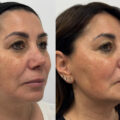 Caso 1 dx obl_Pre e Post
