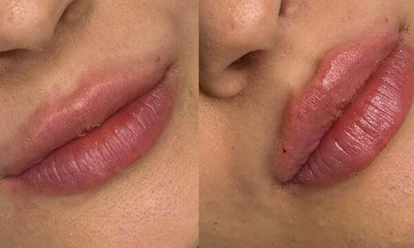 Labbra Caso 66_Pre e post
