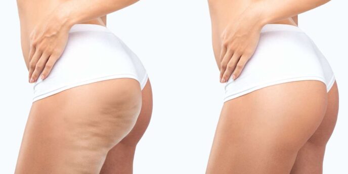 cellulite-radiofrequenza-trattamento