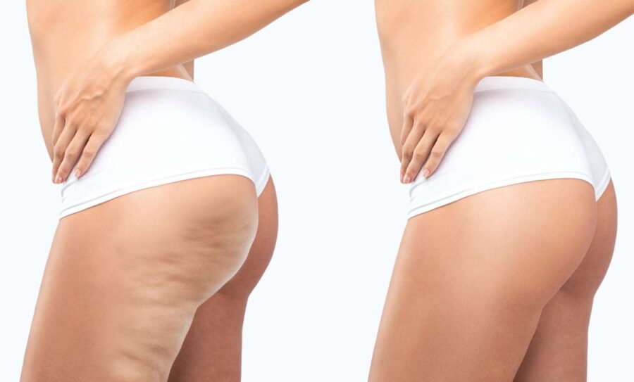 cellulite-radiofrequenza-trattamento