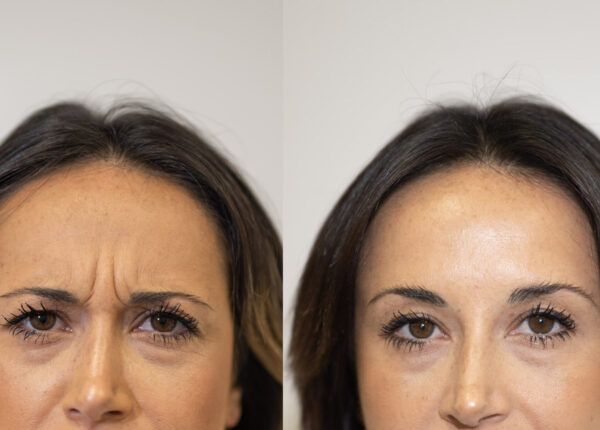 Botox prima e dopo caso 3