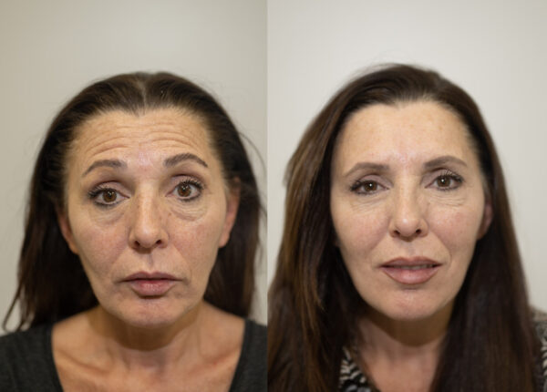 Botox prima e dopo caso 4